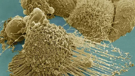 Un análisis de sangre experimental alerta del cáncer cuatro años antes