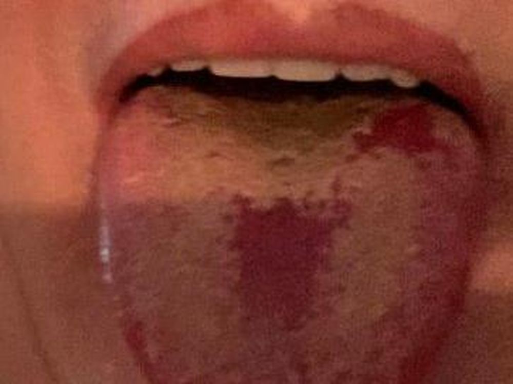 De qué se trata la “lengua Covid”, un síntoma cada vez más frecuente según advierten en Londres