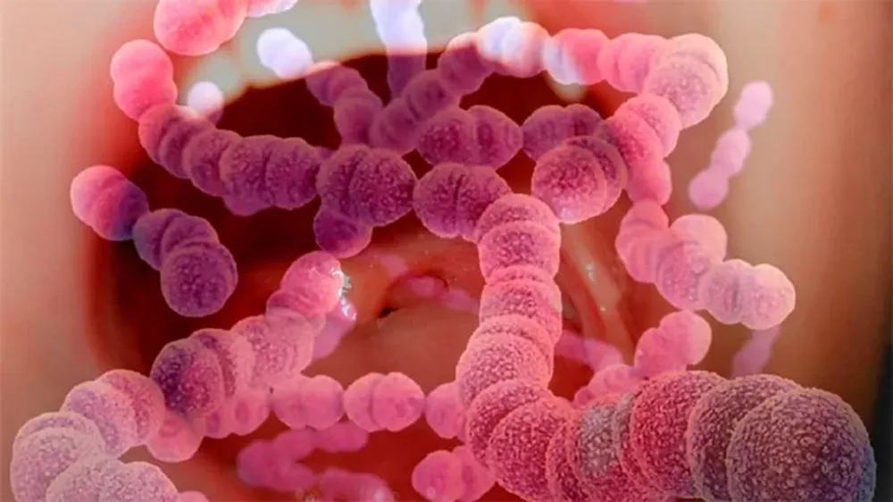 Cuáles son los síntomas de infección invasiva por Streptococcus pyogenes y cómo se trata