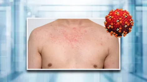 Advierten sobre aumento de casos de sarampión, paperas y hepatitis A en Argentina