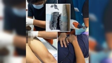 Se agrandó el pene y se le quedó atascado en un tubo