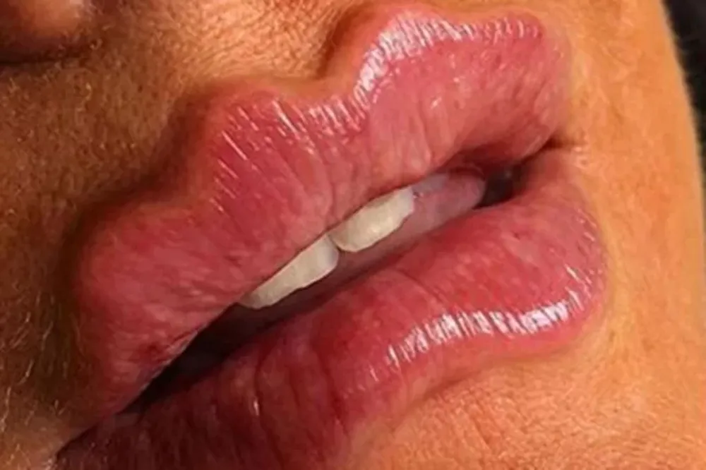 “Labios del diablo”, la peligrosa moda viral