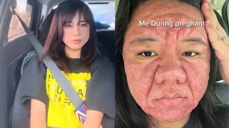 El impactante cambio físico de una joven durante su embarazo: “No me reconocía en el espejo”