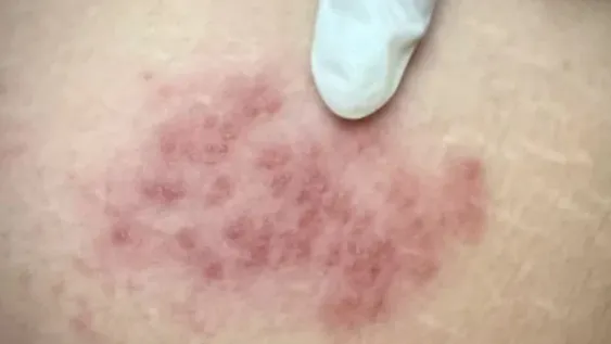 Aprobaron en Argentina una nueva vacuna para prevenir la “culebrilla”