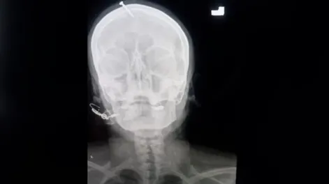 Curandero le puso un clavo en la cabeza a una embarazada para garantizarle que tenga un varón