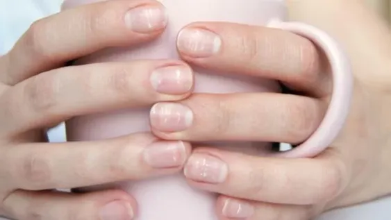 Por qué aparecen puntitos blancos o rayas en las uñas