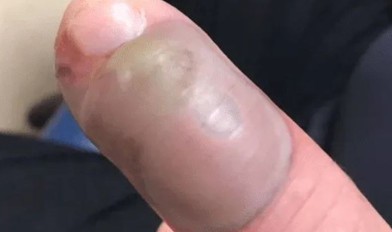 Se mordía las uñas, se le infectó un dedo y casi le cuesta la vida