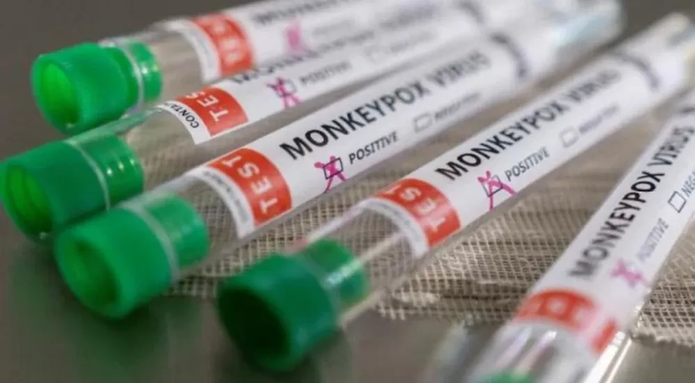 Confirmaron el primer caso de viruela del mono en Argentina