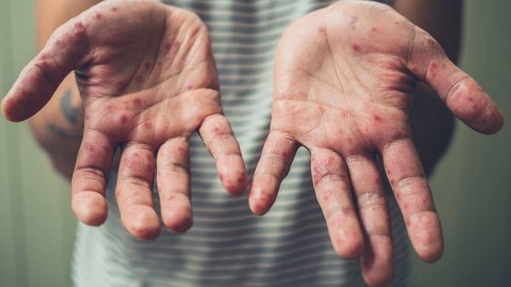 En 2020, más de 22 millones de bebés no fueron vacunados contra el sarampión en el mundo
