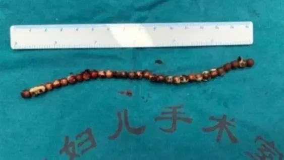 Introdujo 31 bolitas metálicas en su pene
