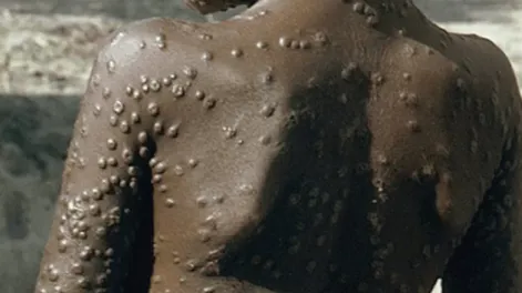 Crece el alerta mundial por avance de viruela del mono