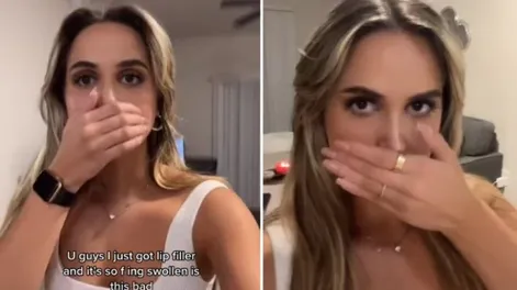 Una influencer se operó los labios y el resultado asustó a sus seguidores