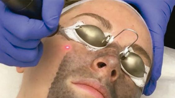 por que todo el mundo habla del tratamiento con laser spectra de hollywood
