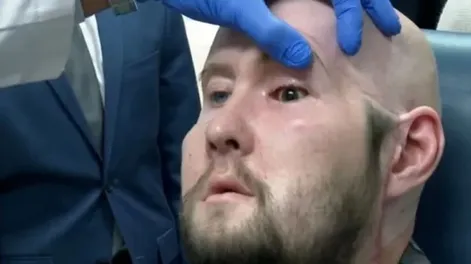 Médicos de Nueva York realizaron con éxito el primer trasplante de ojo del mundo