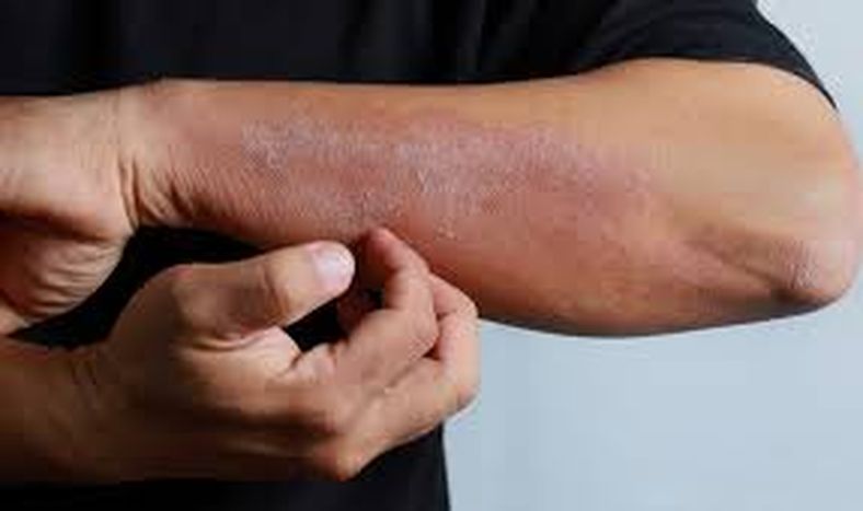 La demora en el acceso al tratamiento puede afectar significativamente la calidad de vida de los pacientes con dermatitis atópica