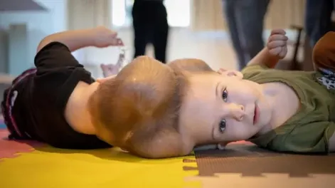 Médicos lograron separar a gemelos unidos por la cabeza