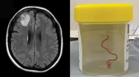 Una mujer sometida a una cirugía y le extrajeron del cerebro a una criatura viva