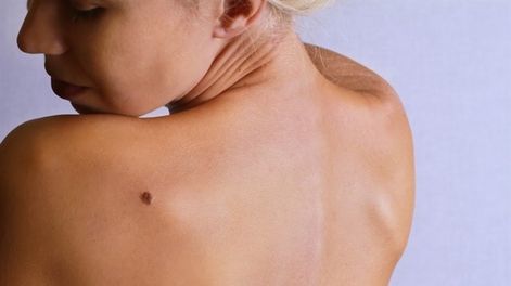 Conocé el significado de tus lunares según su ubicación en el cuerpo