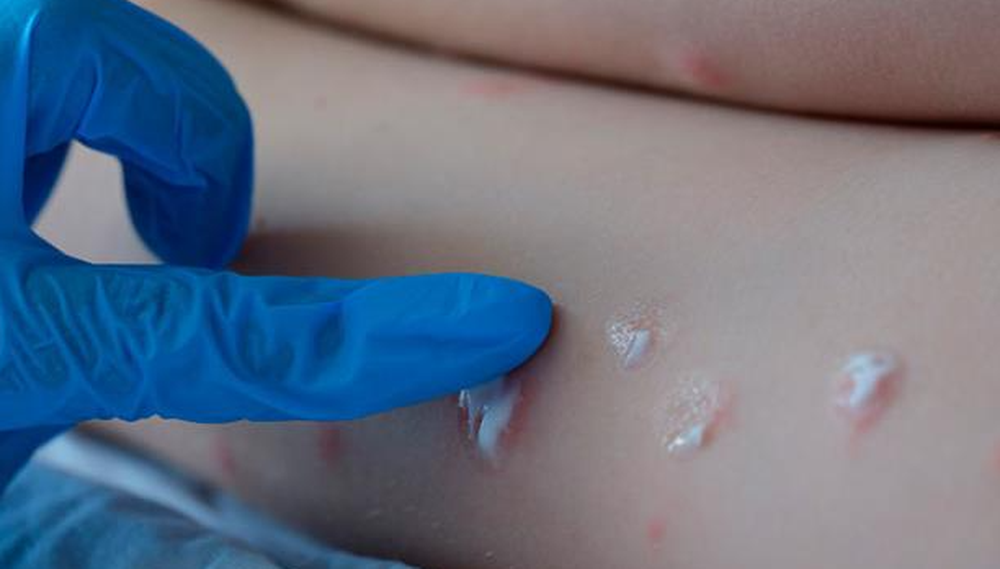 La OMS deja de distinguir países endémicos y no endémicos en datos sobre viruela del mono