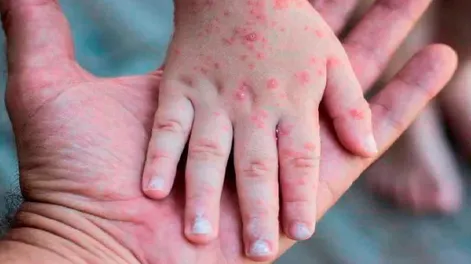 Viruela del mono: la OMS declaró la emergencia internacional por el aumento de casos en el mundo