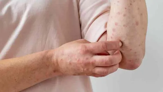 Hay cinco provincias del país con casos confirmados de viruela del mono