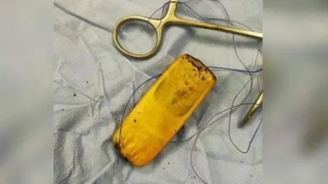 Le dolía mucho la panza y descubrieron que tenía un celular en los intestinos