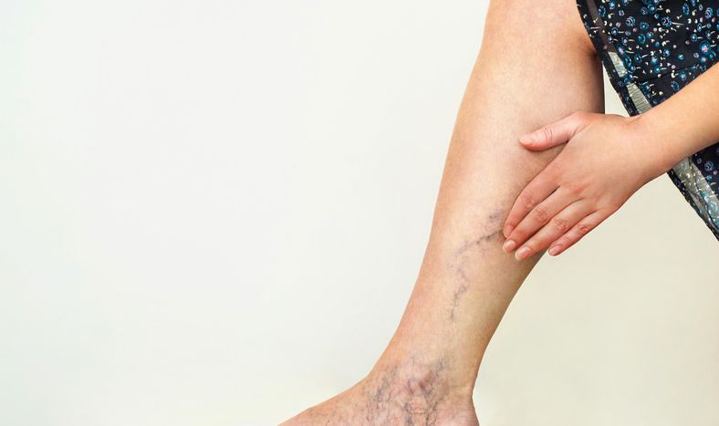 Várices en las piernas: por qué se producen y cómo hay que prevenirlas