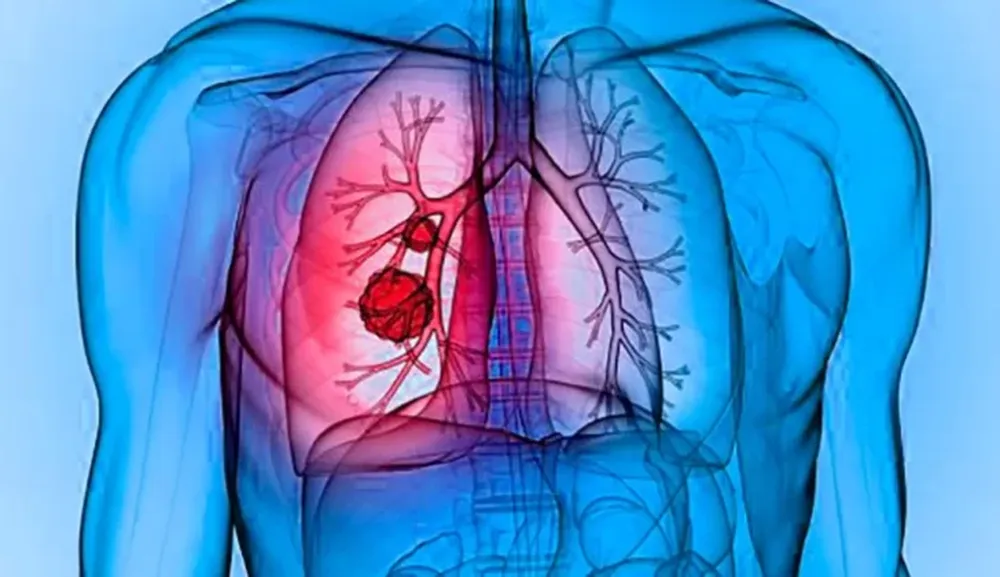 El futuro de la Fibrosis Quística: nuevos desafíos y grandes avances