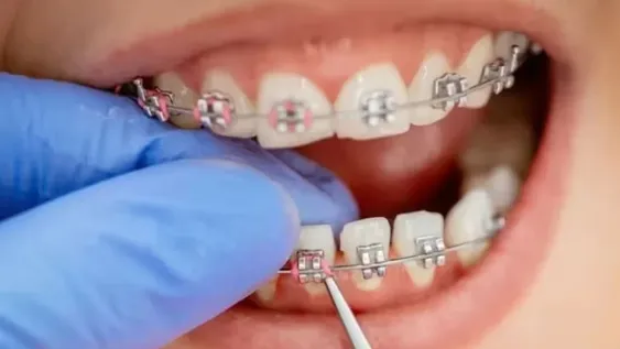 Brackets odontológicos.