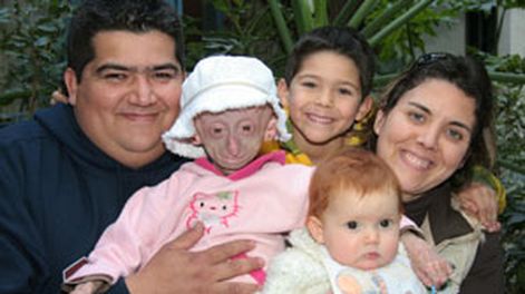 Murió Milagros, la nena que sufría de vejez prematura