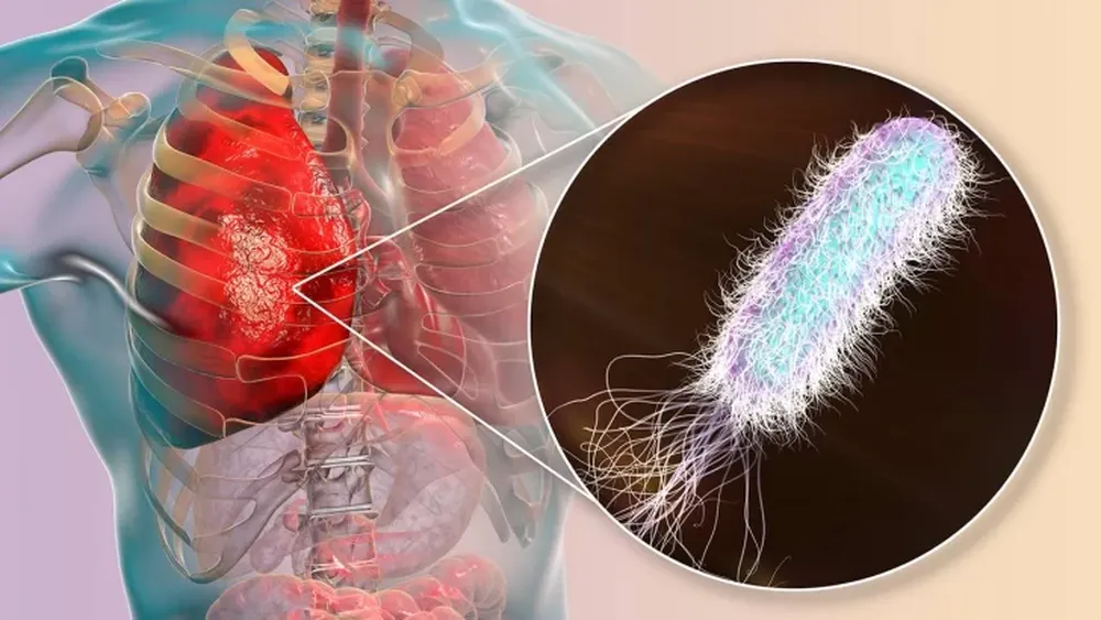 Cambio de paradigmas en el tratamiento de la Fibrosis Quística