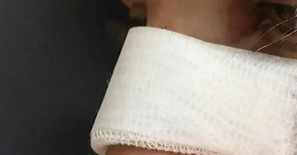 Fue a buscar a su hijo a la casa de su ex, él la atacó y le fracturó el tabique