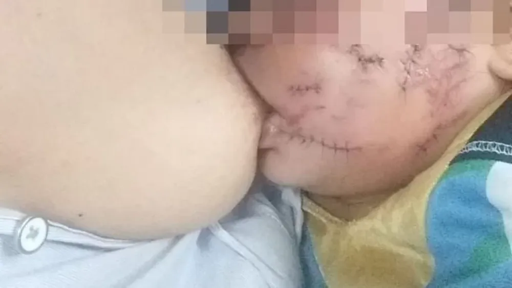 Un pitbull le desfiguró la cara a una beba