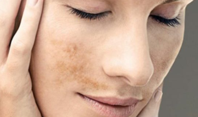 Los 3 alimentos que eliminan las manchas de la cara