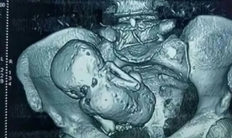 Descubrieron un feto momificado en una mujer de 84 años