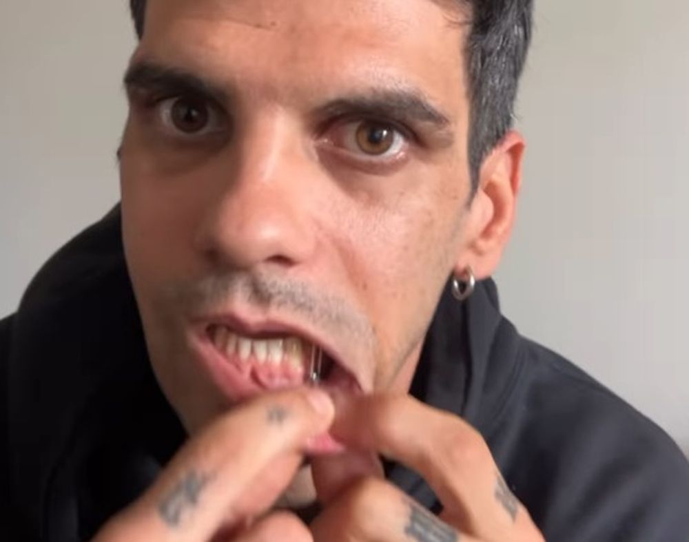 “Estoy atornillado entero”: el empresario de la noche brutalmente golpeado habló de su dura recuperación