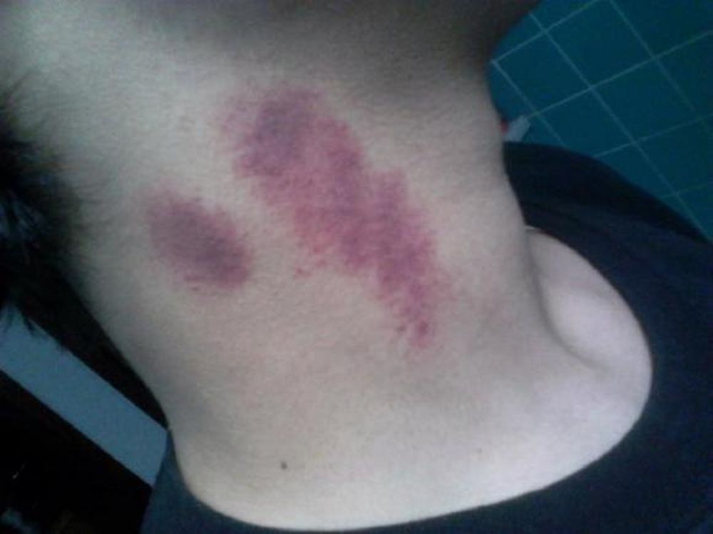 Un joven murió por el apasionado beso de su novia