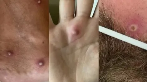 Fue al hospital con síntomas dio positivo de Covid, viruela del mono y VIH