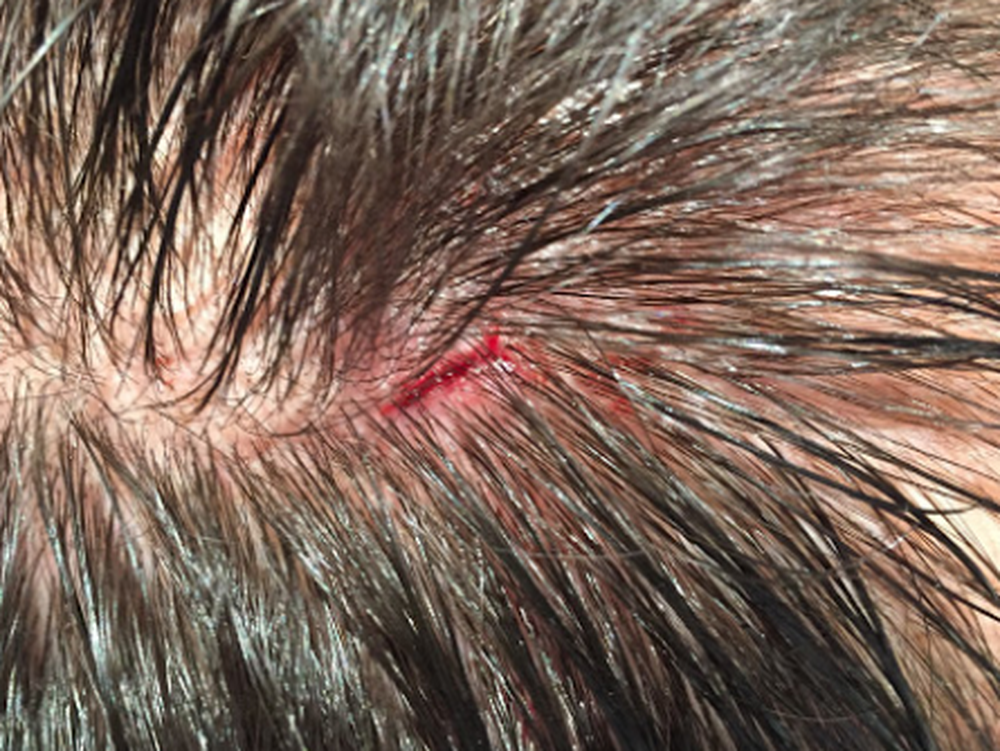 Un perro mordió en la cabeza a un nene 6 años