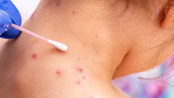 Viruela del mono: ¿las dos franjas etarias que tienen mayor riesgo de contagiarse?