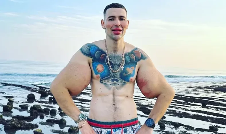 Insólito: se inyectó vaselina en los bíceps para hacerlos más grandes y ahora podrían amputarle ambos brazos