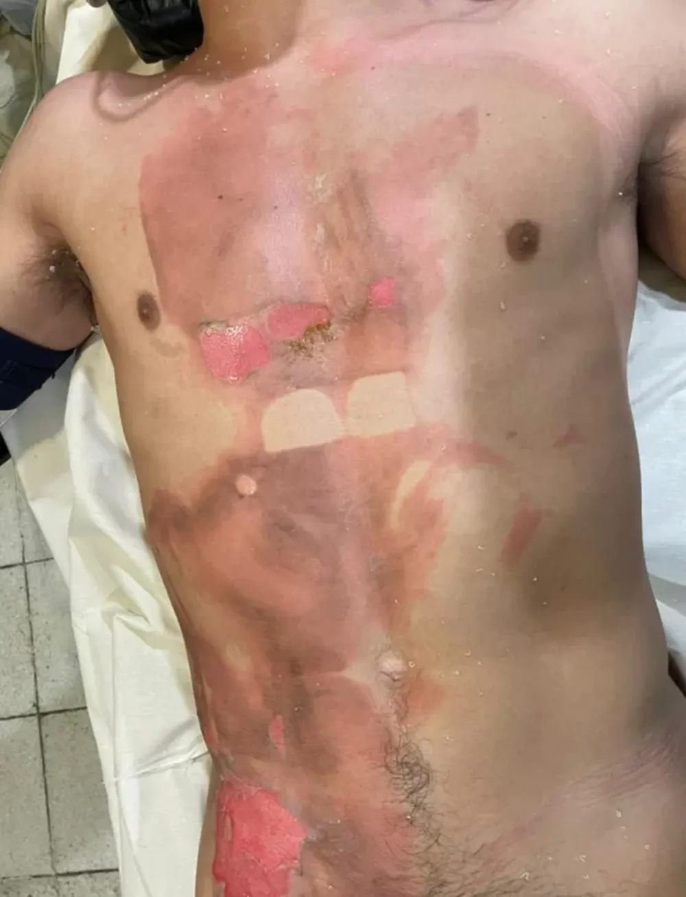 Juan Ignacio Castro Cerdera sufrió lesiones graves tras ser quemado con agua hervida. Según su madre quedó con un profundo daño psicológico.