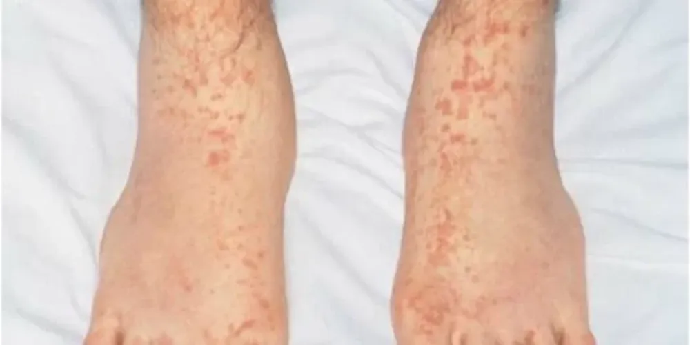 Cómo son las manchas en la piel que pueden indicar que una persona tuvo Covid