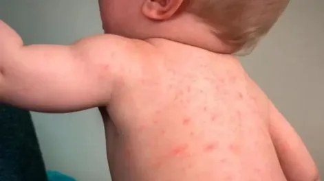 Alerta epidemiológica por nuevos casos de sarampión en Argentina