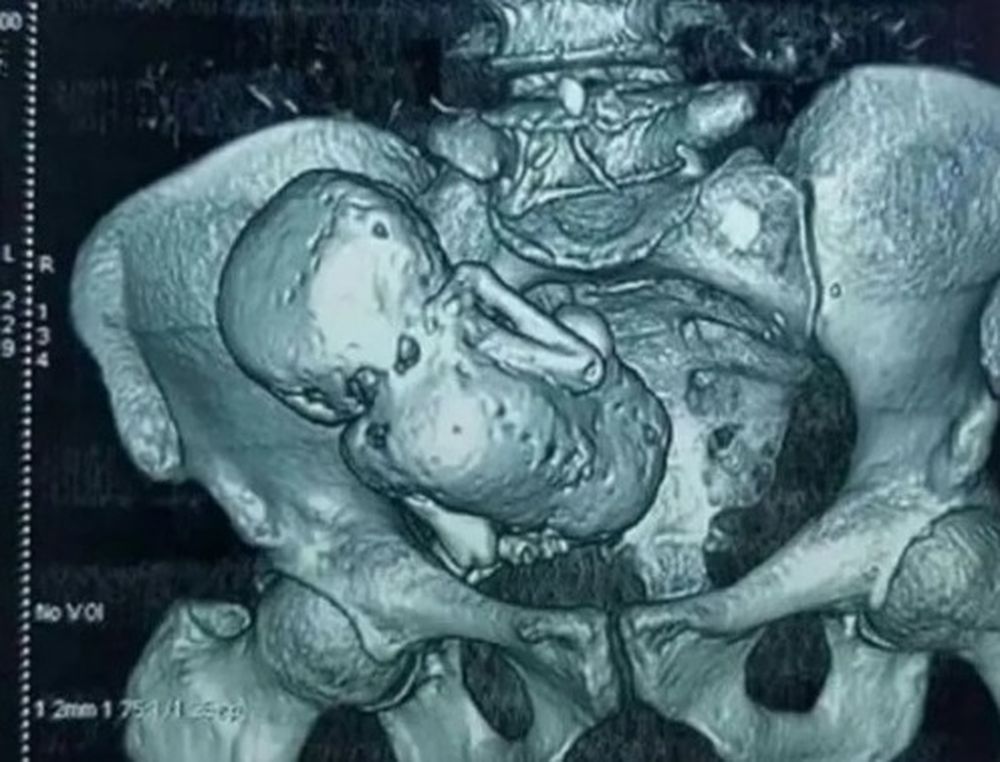Descubrieron un feto momificado en una mujer de 84 años