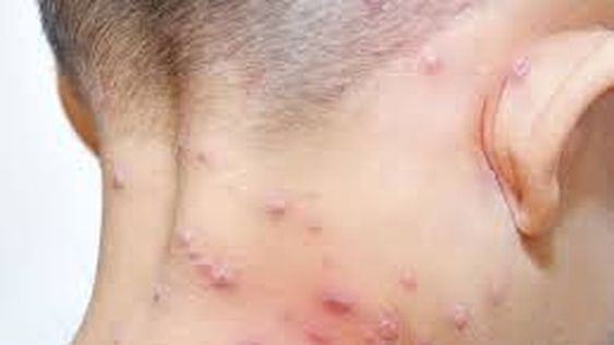 La OMS confirmó más de 5.000 casos de viruela del mono en el mundo