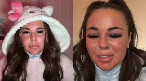 Se sometió a una técnica distinta en la cama solar y terminó quemada.-