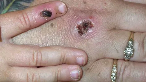 La OMS asegura que la viruela del mono “puede controlarse y el riesgo de transmisión es bajo”