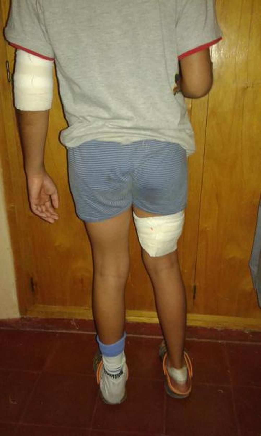 Otra vez un pitbull: se soltó y atacó brutalmente a un nene de 9 años