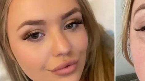 Quiso aumentar el tamaño de sus labios, pero quedó desfigurada